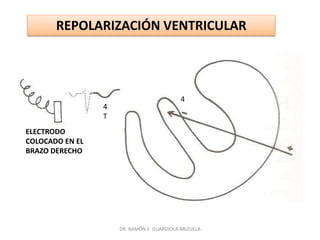 DR. RAMÓN E. GUARDIOLA BRIZUELA
ELECTRODO
COLOCADO EN EL
BRAZO DERECHO
REPOLARIZACIÓN VENTRICULAR
4
T
4
 