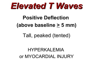 Elevated T Waves Positive Deflection  (above baseline  >  5 mm) Tall, peaked (tented) HYPERKALEMIA  or MYOCARDIAL INJURY 