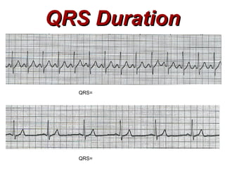 QRS Duration QRS= QRS= 