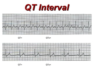 QT Interval QT= QTc= QT= QTc= 