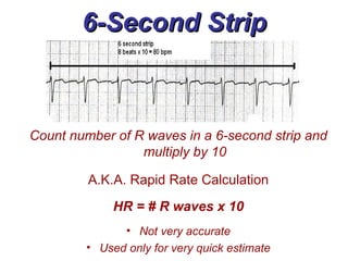 6-Second Strip Count number of R waves in a 6-second strip and multiply by 10 A.K.A. Rapid Rate Calculation HR = # R waves x 10 Not very accurate Used only for very quick estimate 