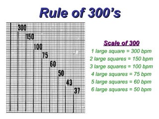 Rule of 300’s Scale of 300 1 large square = 300 bpm 2 large squares = 150 bpm 3 large squares = 100 bpm 4 large squares = 75 bpm 5 large squares = 60 bpm 6 large squares = 50 bpm 