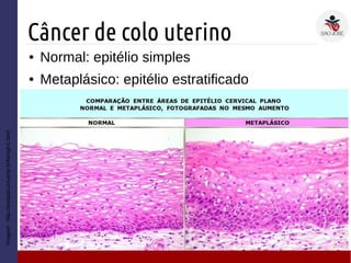 Câncer de colo uterino
Imagem:http://anatpat.unicamp.br/lamgin1.html
● Normal: epitélio simples
● Metaplásico: epitélio estratificado
 