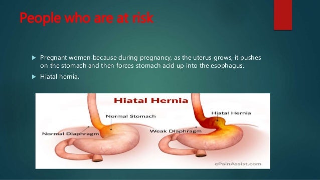 Gastroesophageal Reflux Disease and Exercise (GERD) Gastroesophageal Reflux Disease and Exercise (GERD)