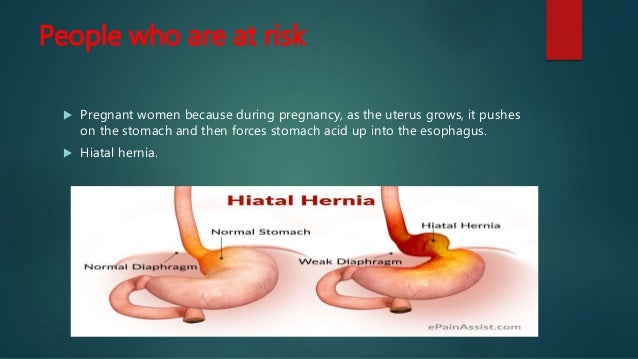 Gastroesophageal Reflux Disease and Exercise (GERD)