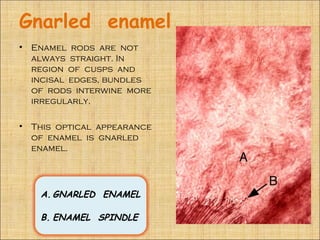 Gnarled enamel
•   Enamel rods are not
    always straight. In
    region of cusps and
    incisal edges, bundles
    of rods interwine more
    irregularly.

•   This optical appearance
    of enamel is gnarled
    enamel.




     A. GNARLED ENAMEL

     B. ENAMEL SPINDLE
 