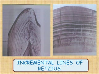 INCREMENTAL LINES OF
      RETZIUS
 