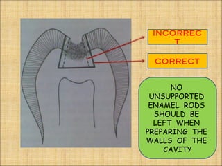 INCORREC
     T

 CORRECT


      NO
 UNSUPPORTED
 ENAMEL RODS
  SHOULD BE
  LEFT WHEN
PREPARING THE
WALLS OF THE
    CAVITY
 
