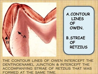 A.CONTOUR
                              LINES
                             OF
                             OWEN.

                           B.STRIAE
                             OF
                             RETZIUS


THE CONTOUR LINES OF OWEN INTERCEPT THE
DENTINOENAMEL JUNCTION & INTERCEPT THE
ACCOMPANYING STRIAE OF RETZIUS THAT WAS
FORMED AT THE SAME TIME.
 
