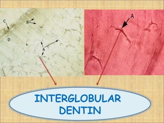 INTERGLOBULAR
    DENTIN
 