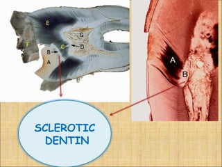 SCLEROTIC
  DENTIN
 