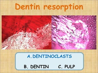 Dentin resorption




   A.DENTINOCLASTS

  B. DENTIN   C. PULP
 