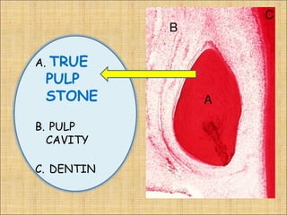 TRUE
A.
 PULP
 STONE

B. PULP
  CAVITY

C. DENTIN
 