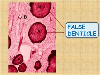 FALSE
DENTICLE
 