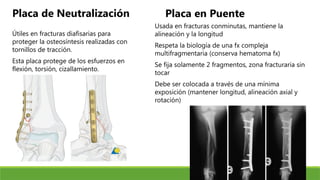 Placa de Neutralización
Útiles en fracturas diafisarias para
proteger la osteosíntesis realizadas con
tornillos de tracción.
Esta placa protege de los esfuerzos en
flexión, torsión, cizallamiento.
Placa en Puente
Usada en fracturas conminutas, mantiene la
alineación y la longitud
Respeta la biología de una fx compleja
multifragmentaria (conserva hematoma fx)
Se fija solamente 2 fragmentos, zona fracturaria sin
tocar
Debe ser colocada a través de una mínima
exposición (mantener longitud, alineación axial y
rotación)
 