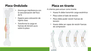 Placa Ondulada
• Disminuye interferencia con
la vascularización del foco
de fx
• Espacio para colocación de
injerto óseo
• Transforma la carga en
fuerzas de tensión pura
sobre la placa
Placa en tirante
4 criterios para actuar como tirante
• Hueso fx debe transmitir carga excéntrica
• Placa sobre el lado de tensión
• Placa debe poder resistir fuerzas de
tensión
• Hueso debe ser capaz de resistir fuerzas
de compresión
 