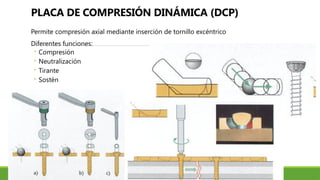PLACA DE COMPRESIÓN DINÁMICA (DCP)
Permite compresión axial mediante inserción de tornillo excéntrico
Diferentes funciones:
◦ Compresión
◦ Neutralización
◦ Tirante
◦ Sostén
 
