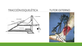 TRACCIÓNESQUELÉTICA TUTOR EXTERNO
 