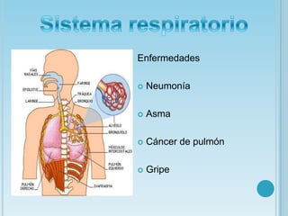 EnfermedadesNeumoníaAsma Cáncer de pulmónGripeSistema respiratorio