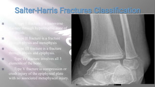  A type 1 fracture is a transverse
fracture through hypertrophic zone of
the physis
 A type II fracture is a fracture
through physis and metaphysis
 A type III fracture is a fracture
through physis and epiphysis.
 Type IV fracture involves all 3
elements of the bone.
 Type V fracture is compression or
crush injury of the epiphyseal plate
with no associated metaphyseal injury.
 