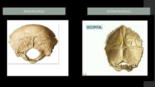 ENDOCRANEAL
EXOCRANEAL
 