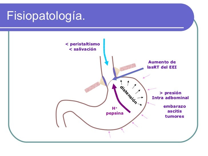 Enfermedad por reflujo gastroesofagico