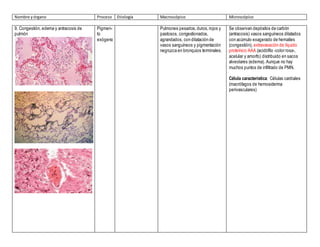 Nombre yórgano Proceso Etiología Macroscópico Microscópico
9. Congestión, edema y antracosis de
pulmón
Pigmen-
to
exógeno
Pulmones pesados,duros,rojos y
pastosos, congestionados,
agrandados, con dilatación de
vasos sanguíneos y pigmentación
negruzca en bronquios terminales.
Se observan depósitos de carbón
(antracosis) vasos sanguíneos dilatados
con acúmulo exagerado de hematíes
(congestión), extravasación de líquido
proteínico AAA (acidófilo -color rosa-,
acelular y amorfo) distribuido en sacos
alveolares (edema). Aunque no hay
muchos puntos de infiltrado de PMN.
Célula característica: Células cardiales
(macrófagos de hemosiderina
perivasculares)
 