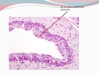 Ep. de reves. estratificado
polimorfo.
 