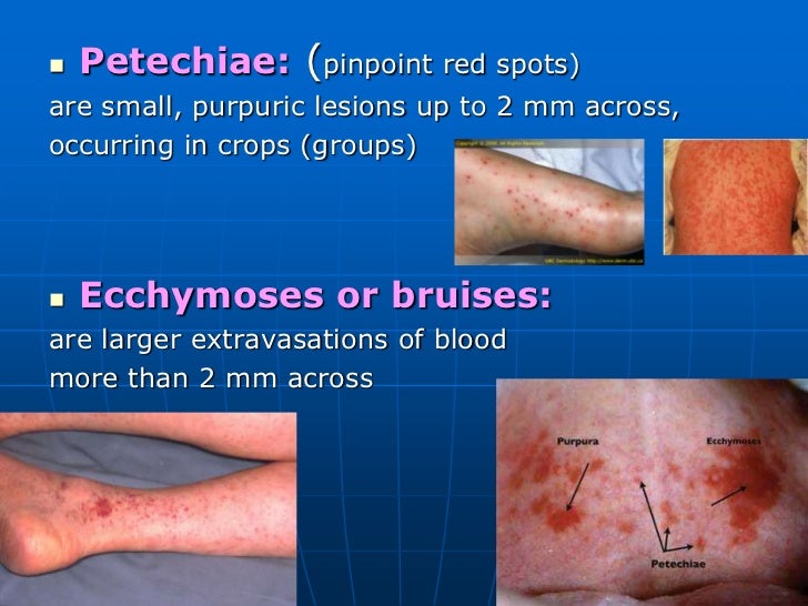Petechiae - Pictures, Symptoms, Causes, Treatment