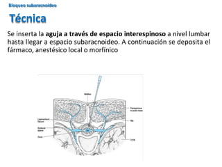 Se inserta la aguja a través de espacio interespinoso a nivel lumbar
hasta llegar a espacio subaracnoideo. A continuación se deposita el
fármaco, anestésico local o morfínico
Técnica
Bloqueo subaracnoideo
 