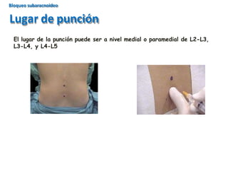 El lugar de la punción puede ser a nivel medial o paramedial de L2-L3,
L3-L4, y L4-L5
Lugar de punción
Bloqueo subaracnoideo
 
