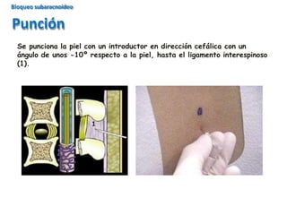 Se punciona la piel con un introductor en dirección cefálica con un
ángulo de unos -10º respecto a la piel, hasta el ligamento interespinoso
(1).
Punción
Bloqueo subaracnoideo
 