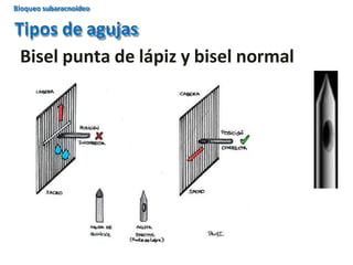 Tipos de agujas
Bisel punta de lápiz y bisel normal
Bloqueo subaracnoideo
 