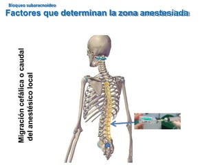 Factores que determinan la zona anestesiada
Migración
cefálica
o
caudal
del
anestésico
local
Bloqueo subaracnoideo
 