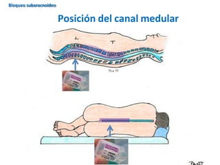 T5 a T7
Posición del canal medular
Bloqueo subaracnoideo
 