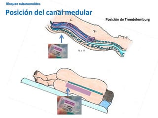 T5 a T7
Posición del canal medular
Bloqueo subaracnoideo
Posición de Trendelemburg
 