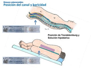 T5 a T7
Bloqueo subaracnoideo
Posición del canal y baricidad
Posición de Trendelemburg y
Solución hipobárica
 