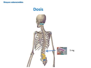 Dosis
5 mg
Bloqueo subaracnoideo
 