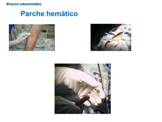 Parche hemático
Bloqueo subaracnoideo
 