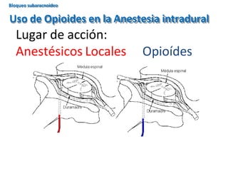 Uso de Opioides en la Anestesia intradural
Lugar de acción:
Anestésicos Locales Opioídes
Bloqueo subaracnoideo
 