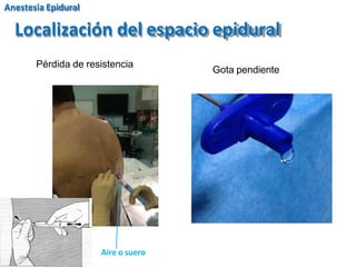 Gota pendiente
Pérdida de resistencia
Aire o suero
Anestesia Epidural
Localización del espacio epidural
 