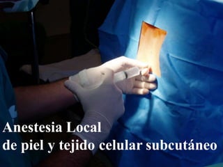 Anestesia Local
de piel y tejido celular subcutáneo
 