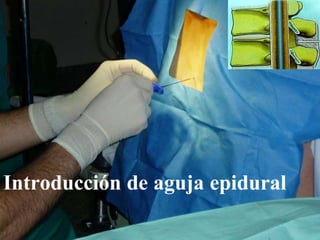 Introducción de aguja epidural
 