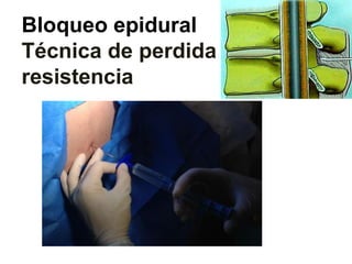 Bloqueo epidural
Técnica de perdida de
resistencia
 
