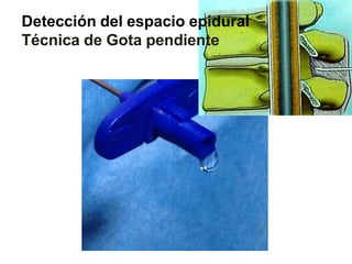 Detección del espacio epidural
Técnica de Gota pendiente
 