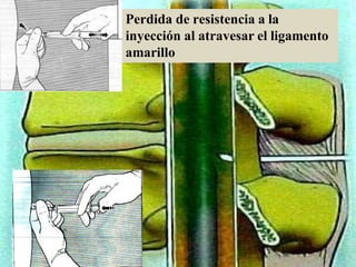 Perdida de resistencia a la
inyección al atravesar el ligamento
amarillo
 