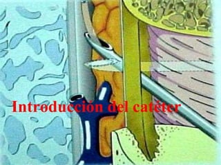 Introducción del catéter
 