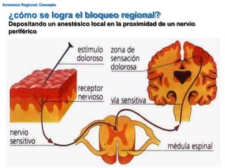 ¿cómo se logra el bloqueo regional?
Depositando un anestésico local en la proximidad de un nervio
periférico
Anestesia Regional, Concepto
 