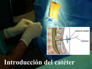 Introducción del catéter
 