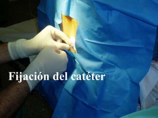 Fijación del catéter
 